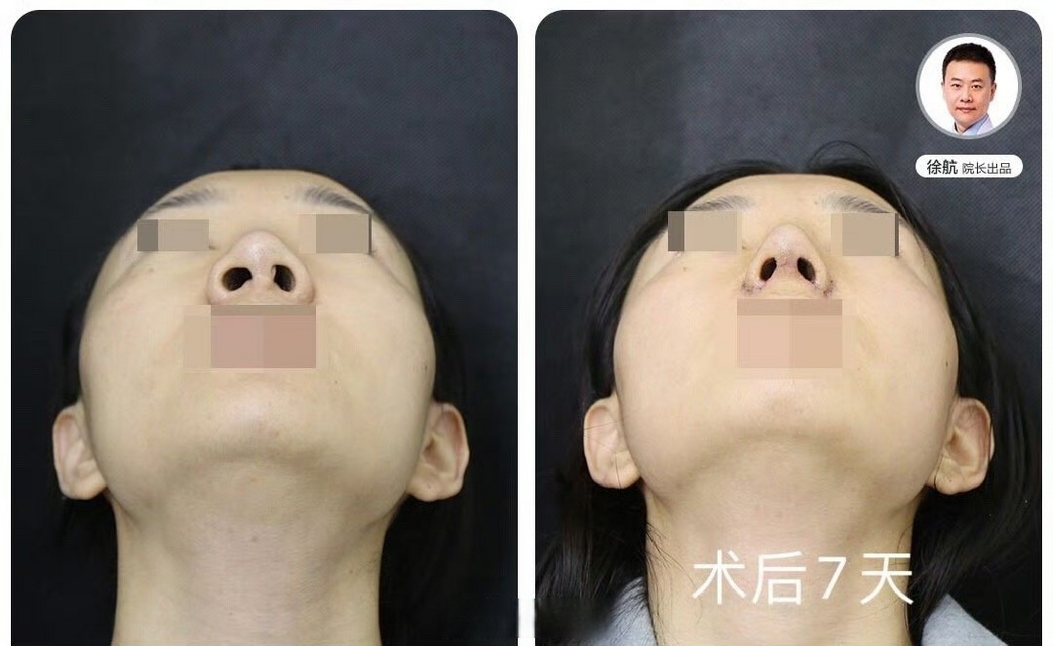 对于大鼻头宽鼻翼的,外切鼻翼是鼻头能缩这么小的关键.