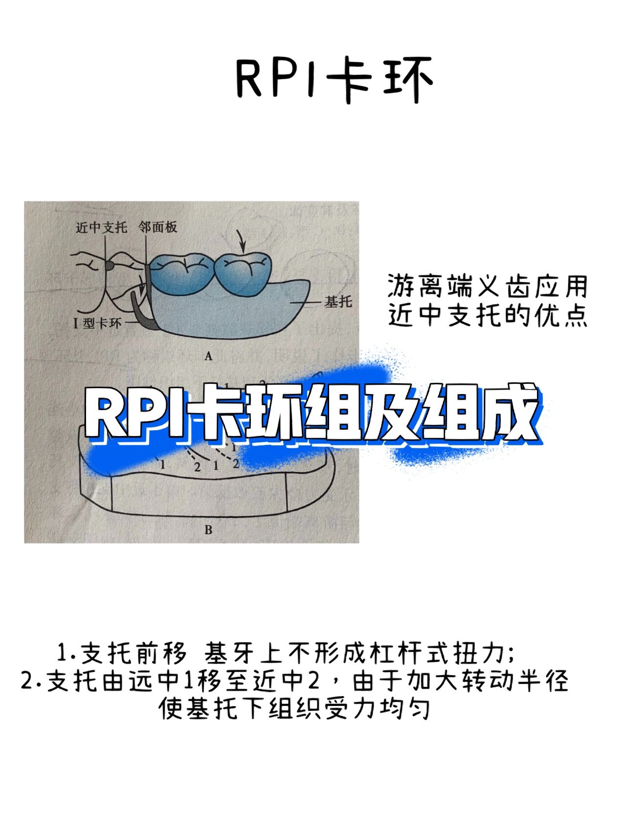 rpi卡环组组成及优缺点