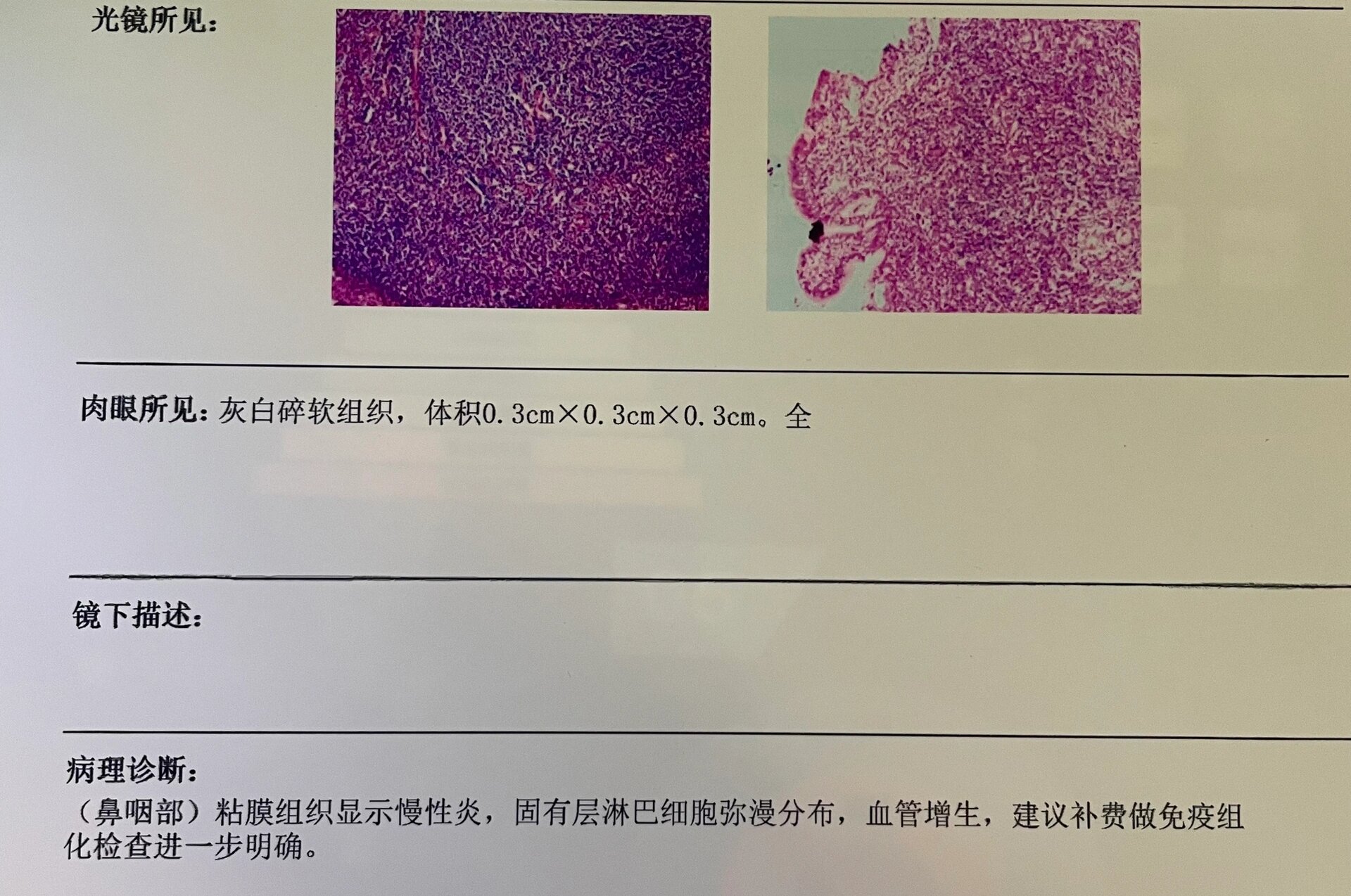 鼻咽癌病理报告图片