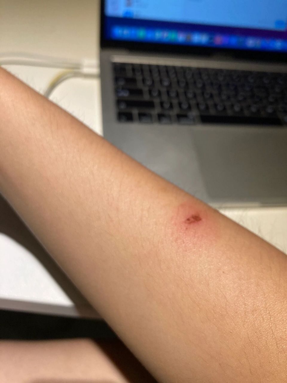 有创口别游泳98 一开始起了个水泡我给戳破了直接下水游泳了,结果