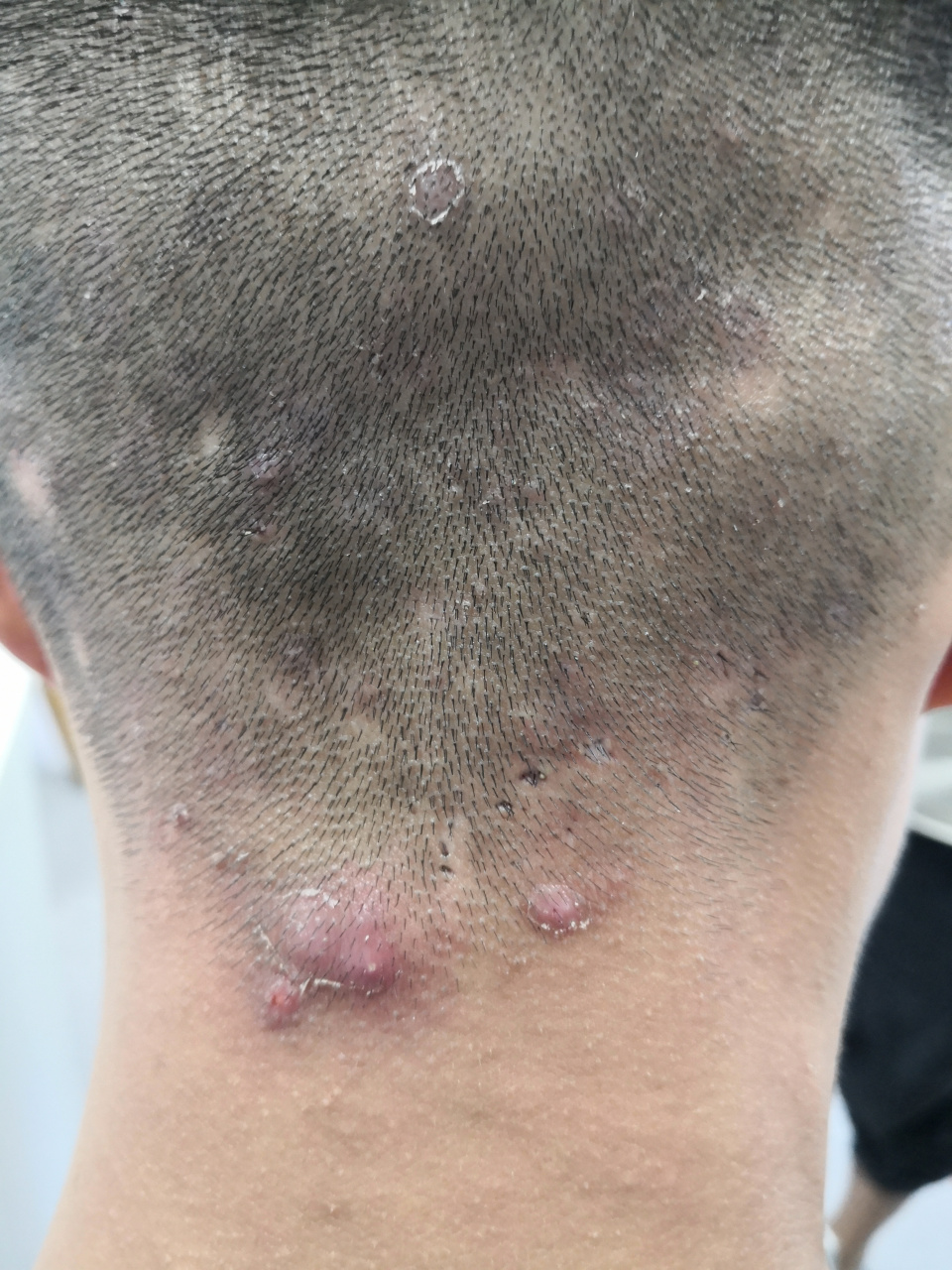 头皮毛囊炎症状.毛囊炎发病部位出现斑片状脱发.秃发性毛囊炎.