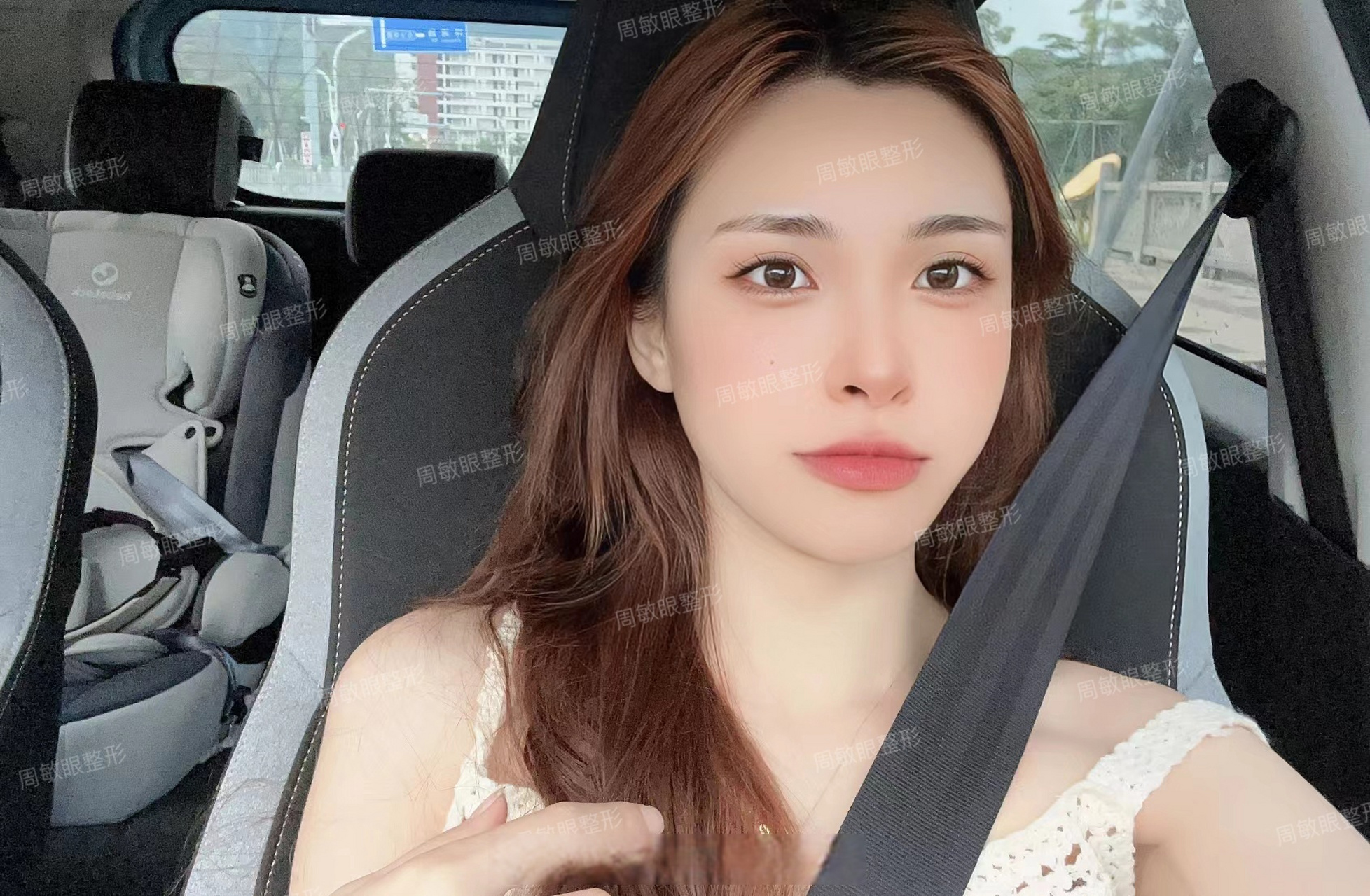 平扇型双眼皮案例,术后3个月反馈~#周敏双眼皮##切开重睑术
