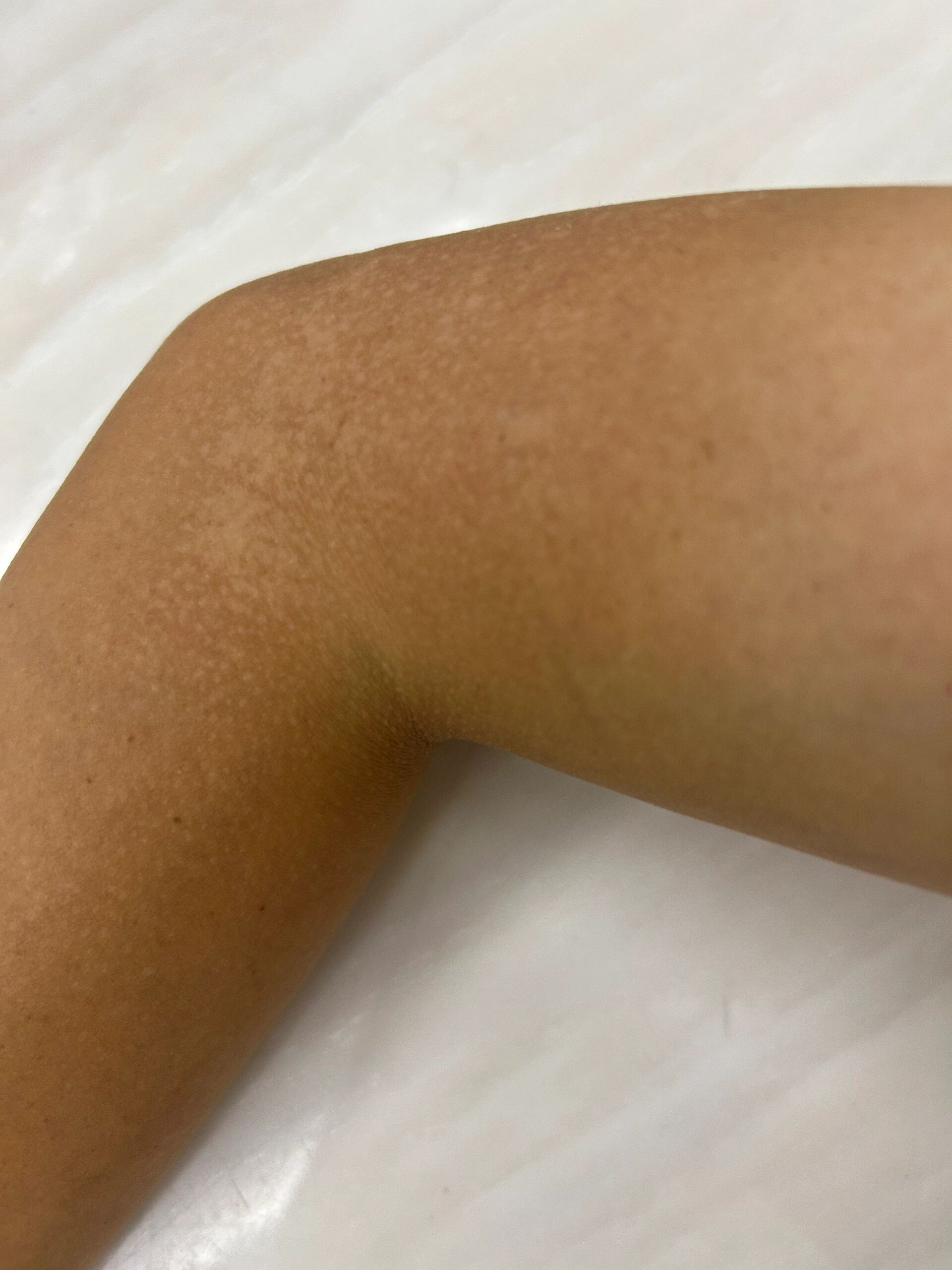 晒伤后第10天,我的胳膊开始脱皮了05 黑也就算了,怎么还褪皮了,还一