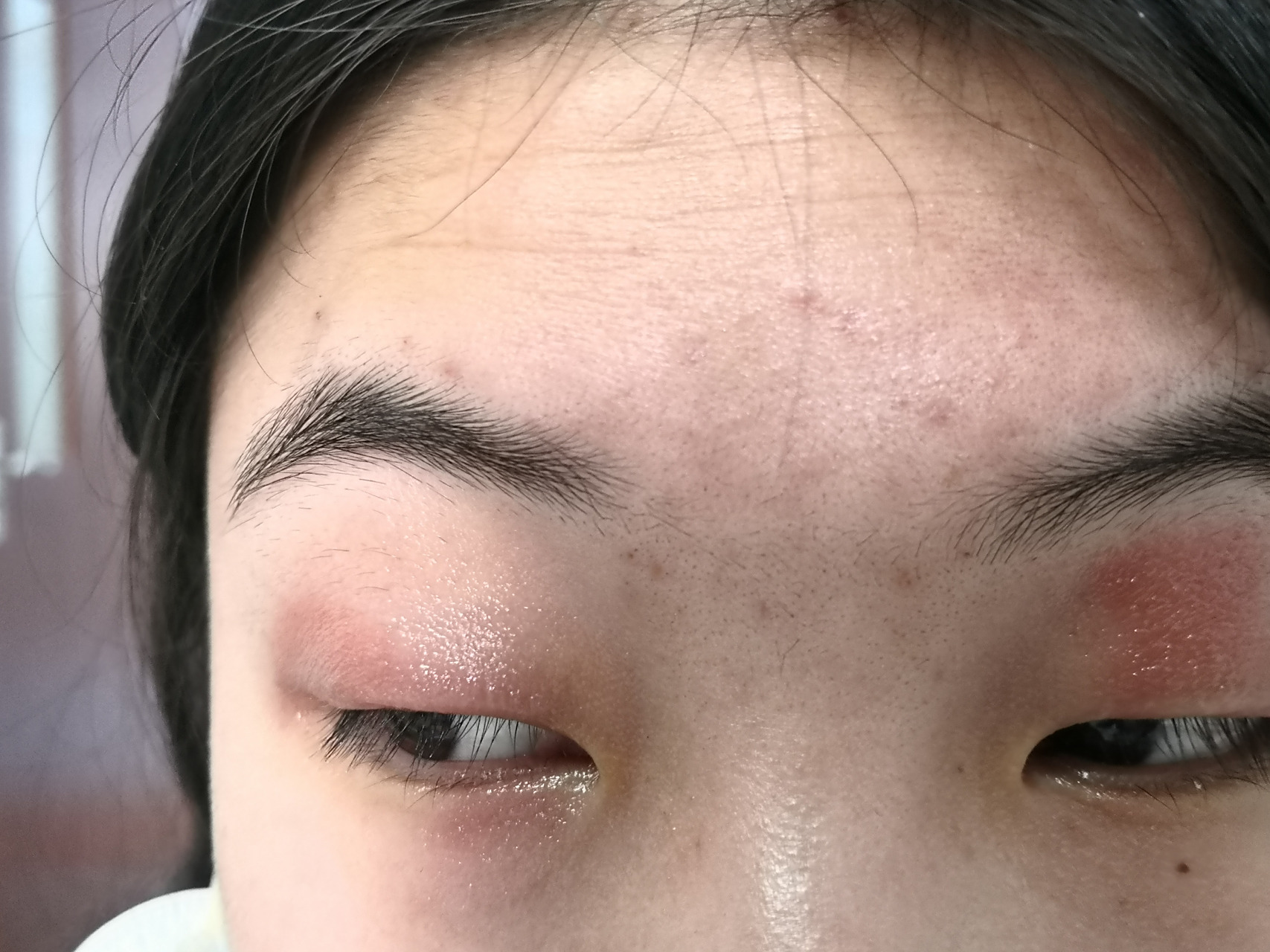 眼睑红斑肿胀明显,瘙痒.考虑护肤品过敏导致的接触性皮炎症状.