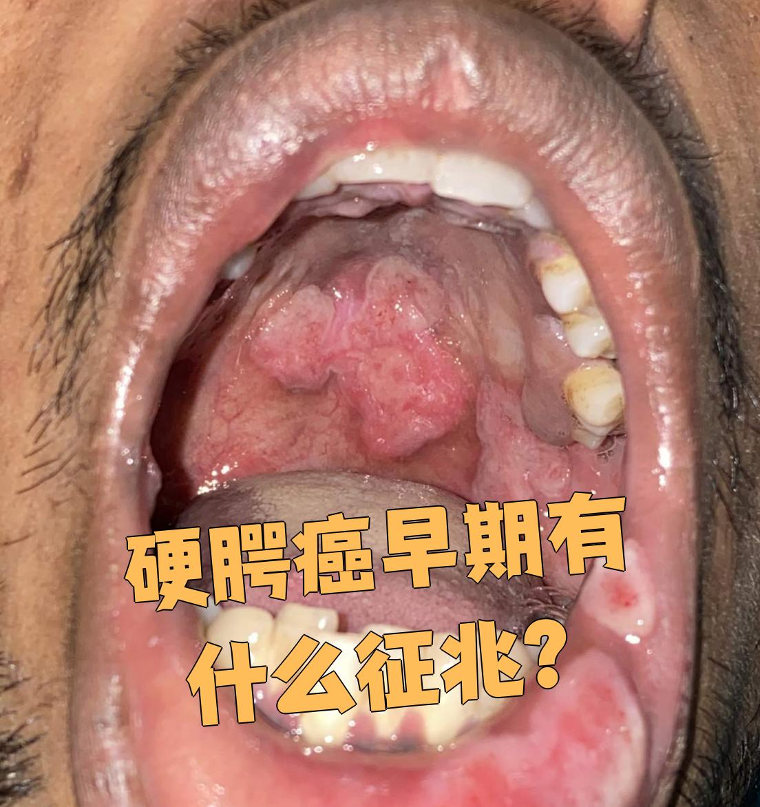 硬腭癌早期最明显的症状是口腔里长肿块
