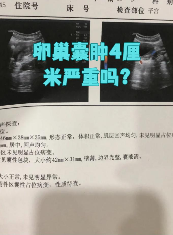 4厘米的卵巢囊肿是否严重要看具体情况