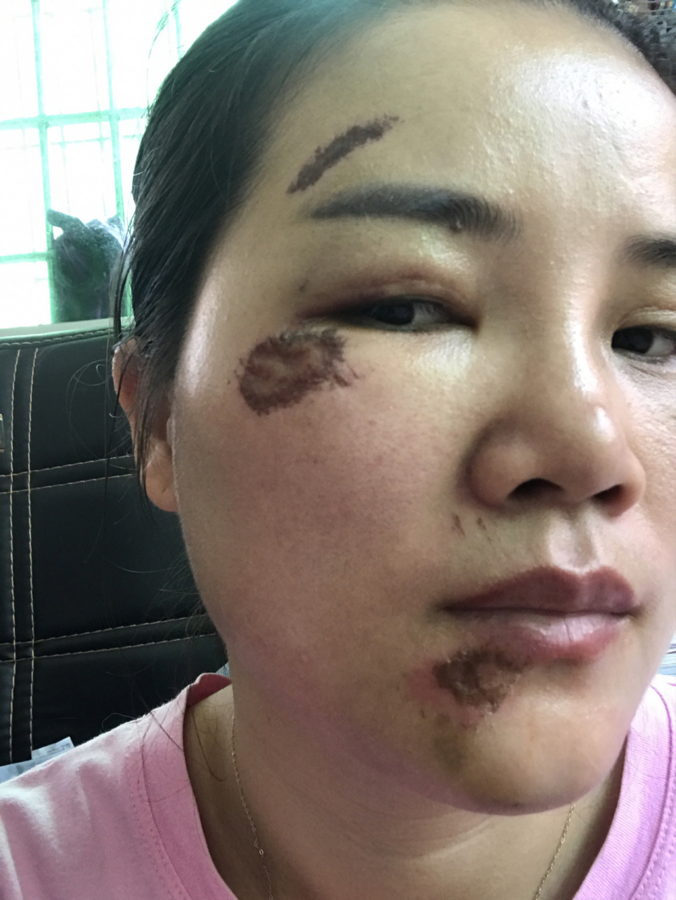 摔伤第四天,脸上开始结痂准备脱落了.