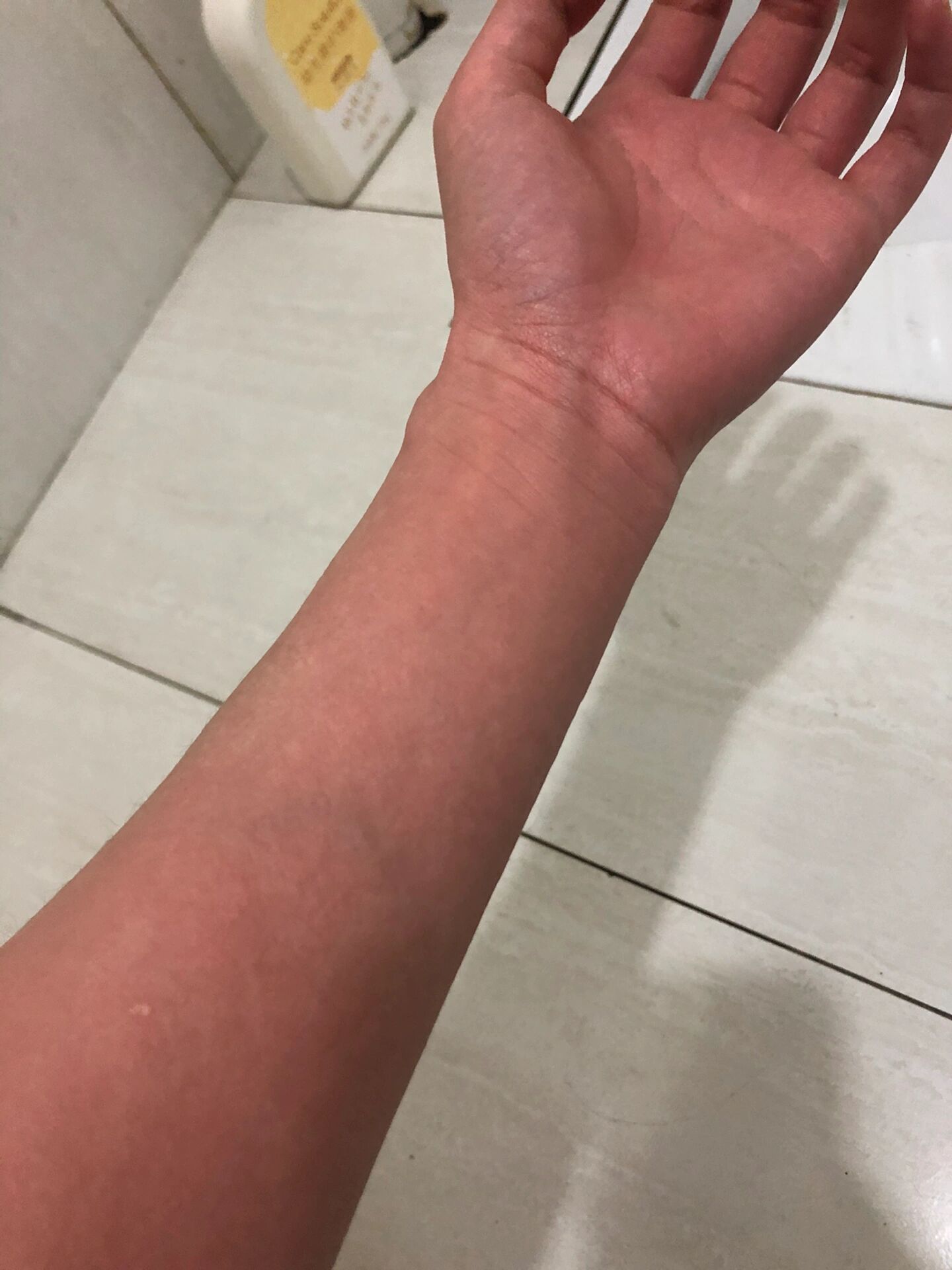 吃小龙虾过敏了 谁懂啊,之前吃的少没有过敏过,结果,今天一次性吃太多