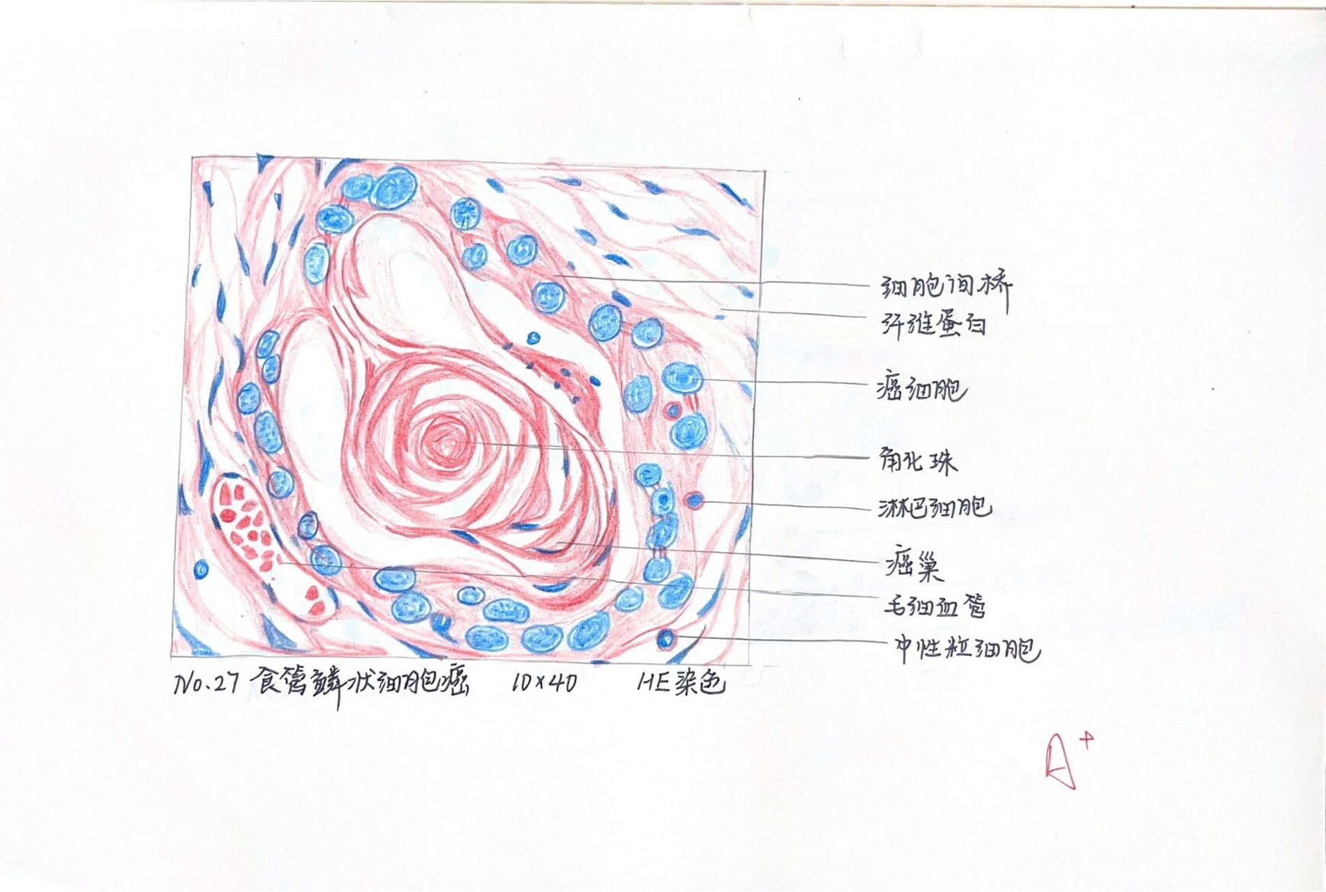 病理学绘图-食管鳞状细胞癌