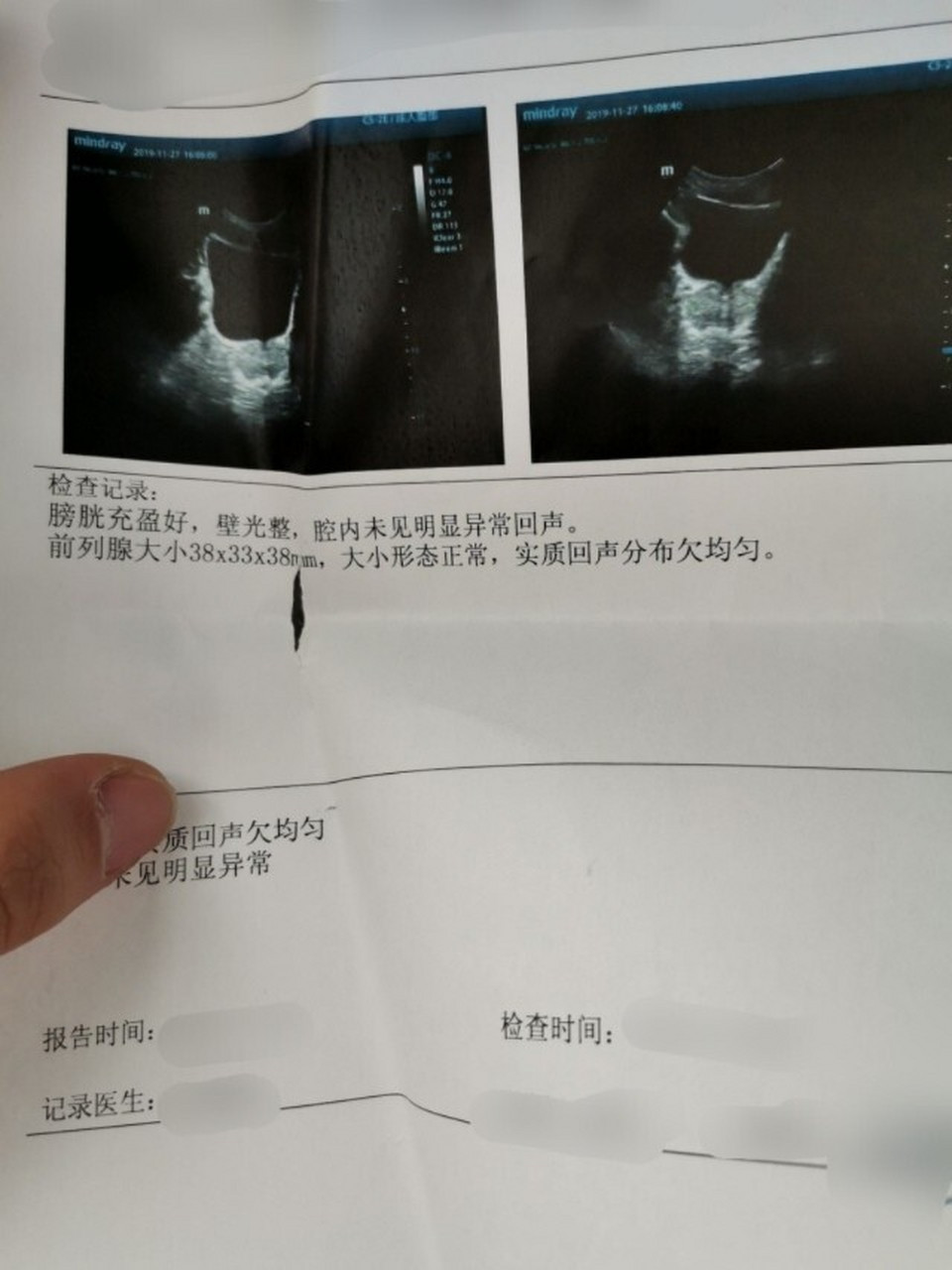 怎样看前列腺液化验单图片