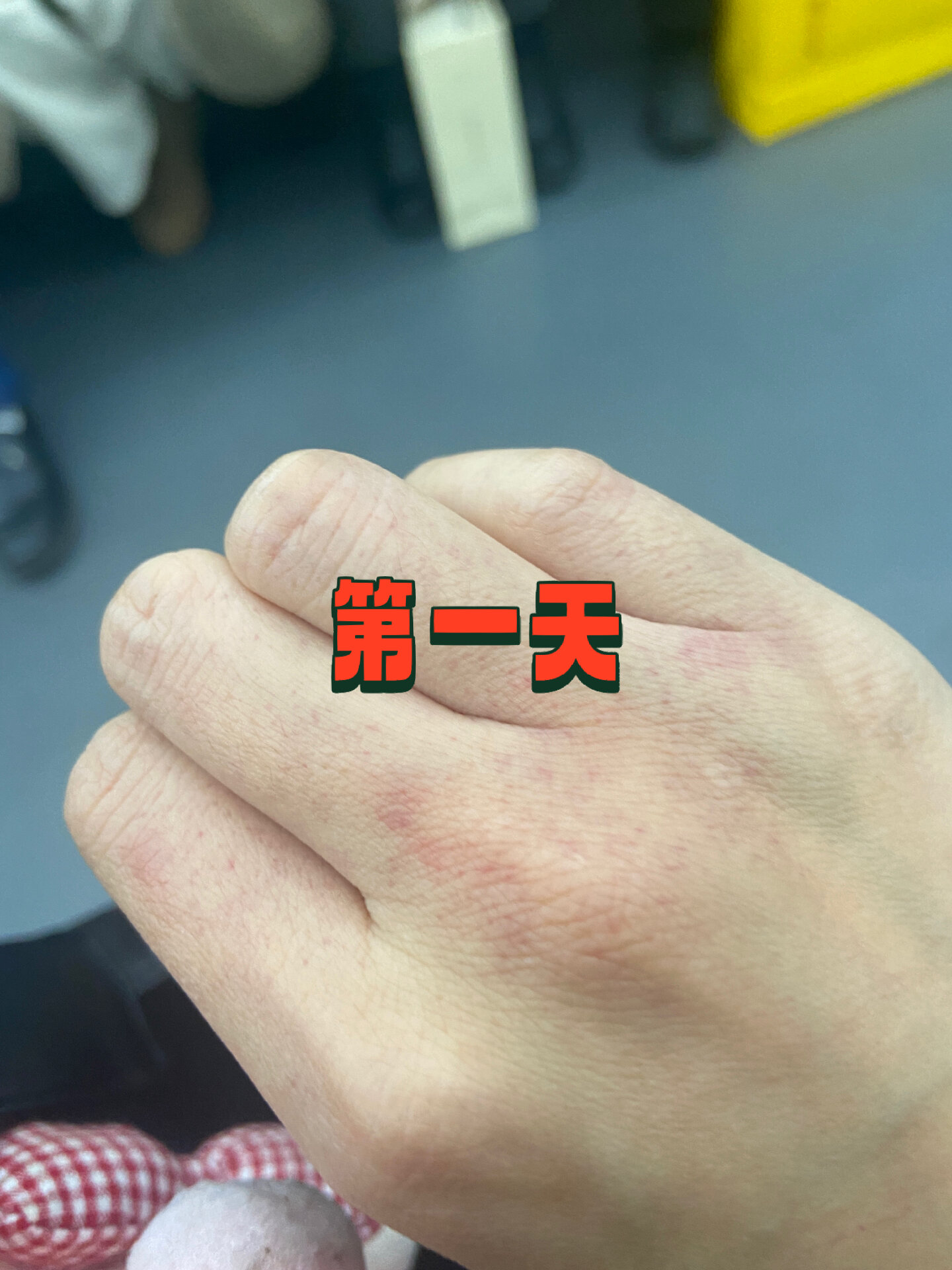 昨天下班手背上突然出现这种小红点,不痛不痒,就一只手上有,然后晚上