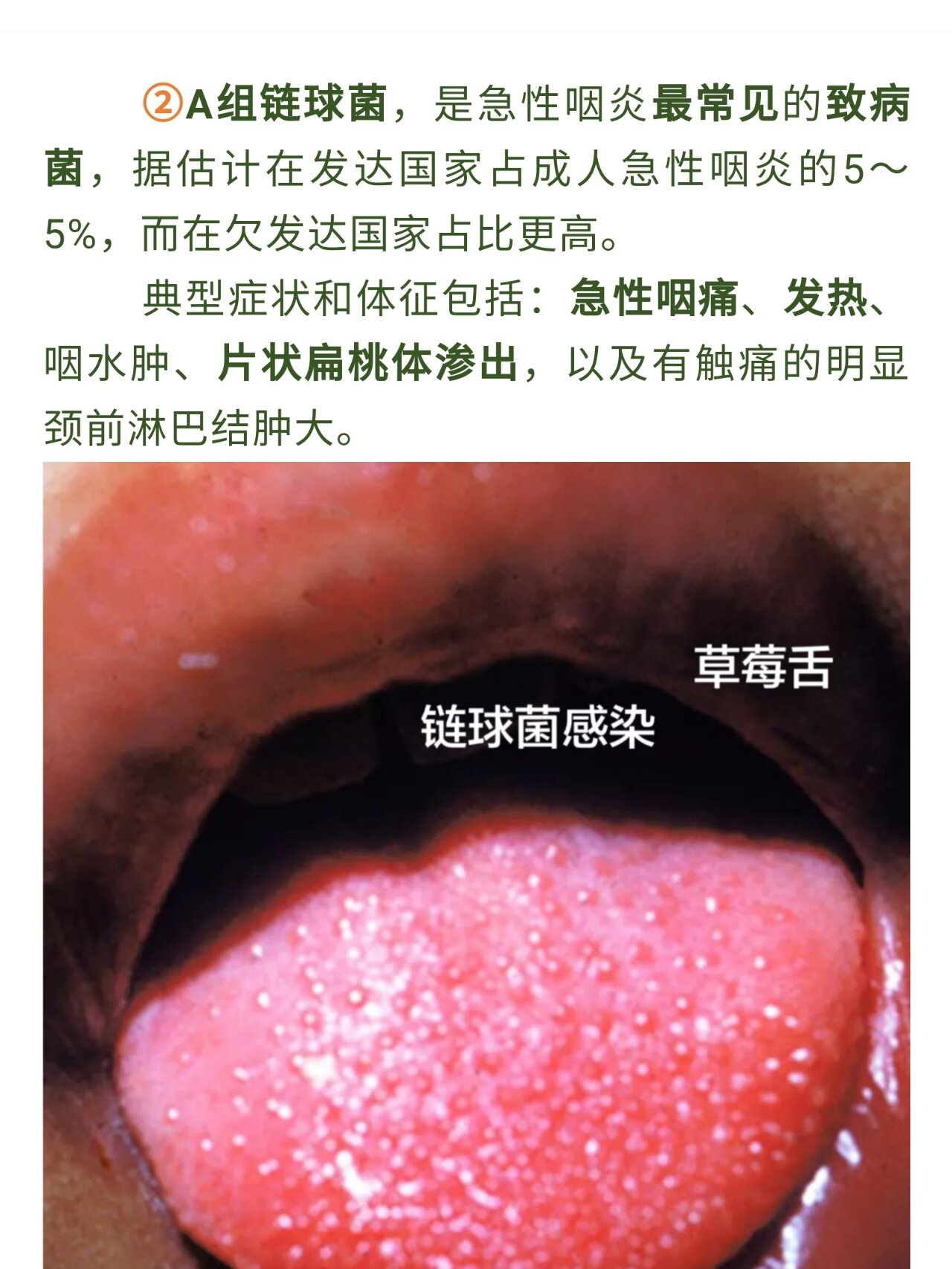 链球菌性咽炎 细菌性咽炎,嗓子会特别疼. 赶紧吃抗生素.