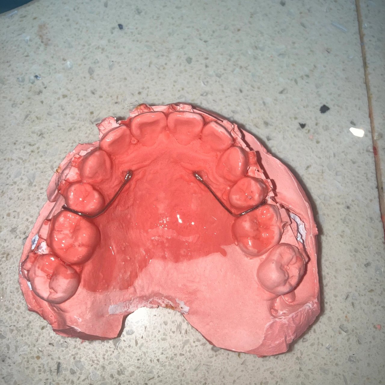 佩戴平导的作用是:打开咬合,治疗深覆合问题;压低下前牙,促进后牙生长