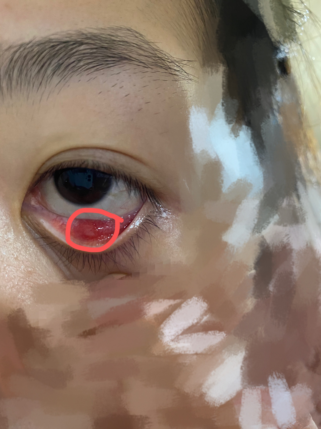 下眼皮子里面长了一颗黄色的水泡一样的东西