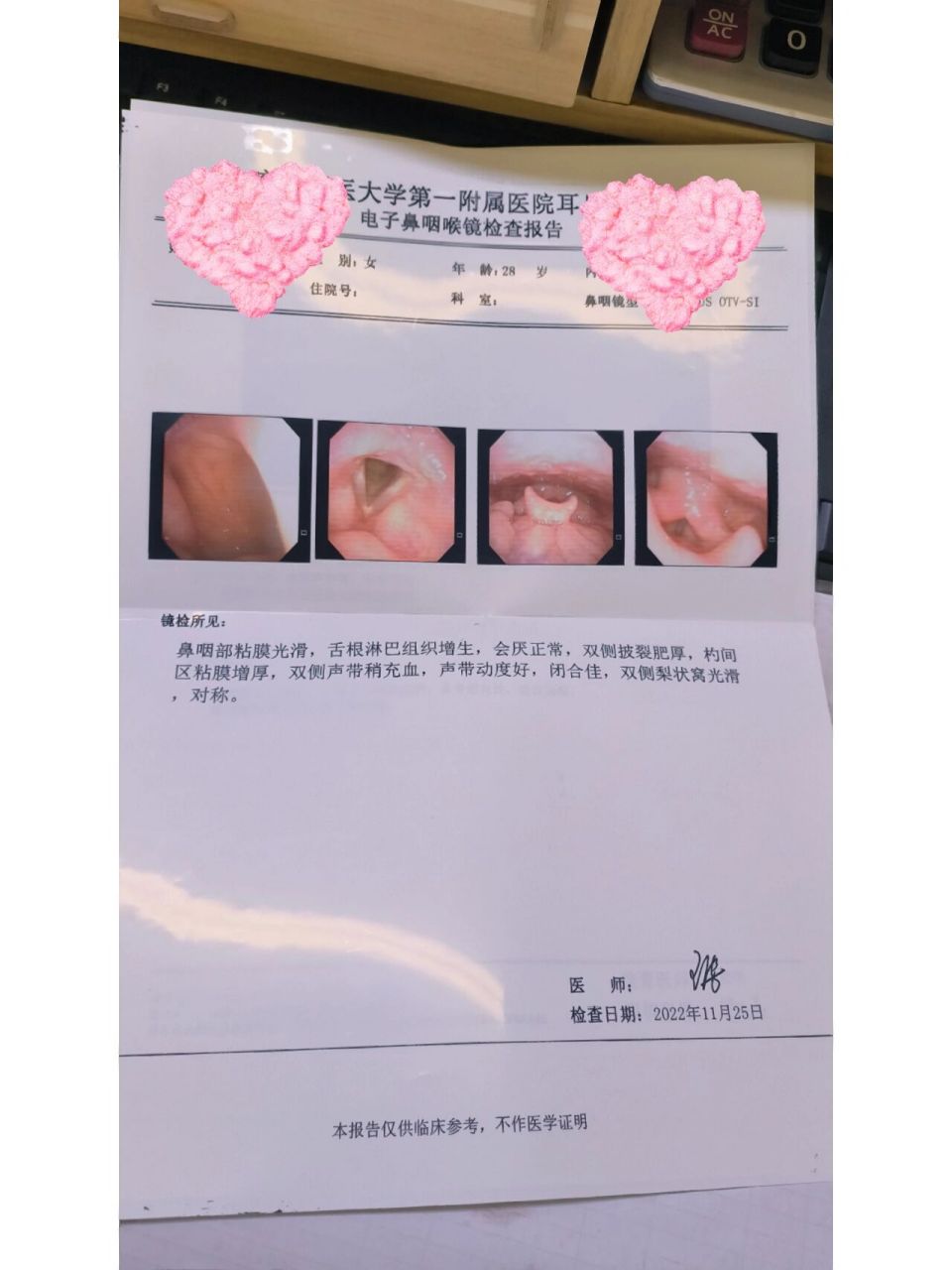 反流性咽喉炎 喉咙感觉有异物感,一个月了,小区附近的医院先看的,开了