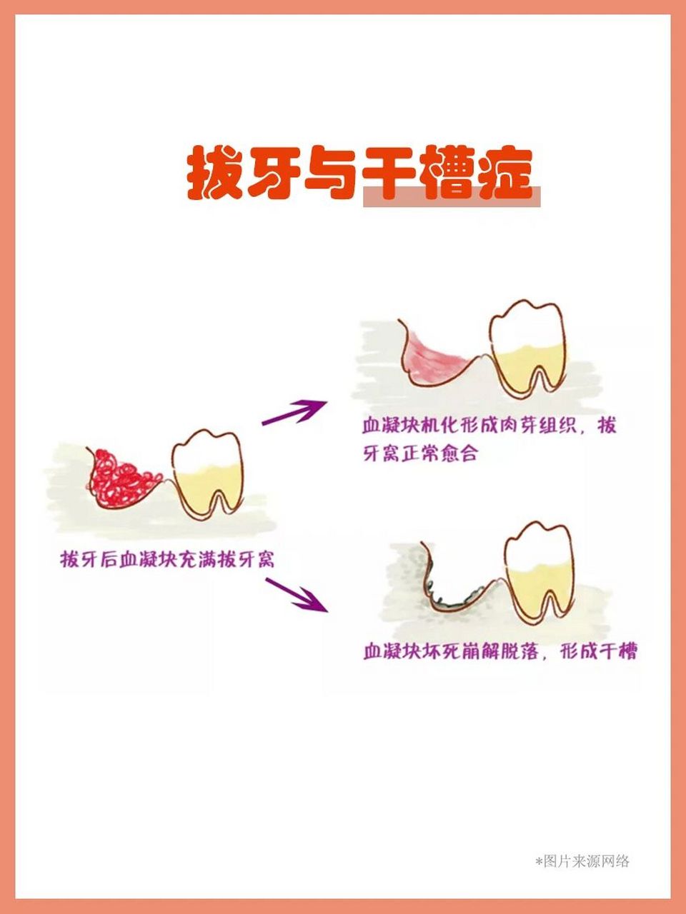 光说干槽症,你可能疑惑这是啥?