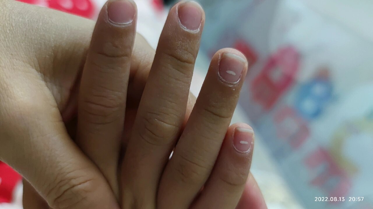 小孩手指有白点是什么原因?