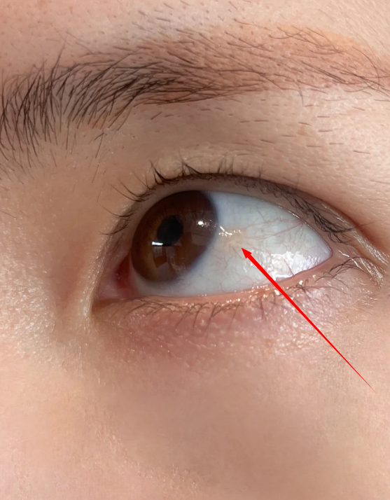 结膜炎会让球结膜水肿,形成白色结节状的隆起.这种情况可以用左氧氟沙