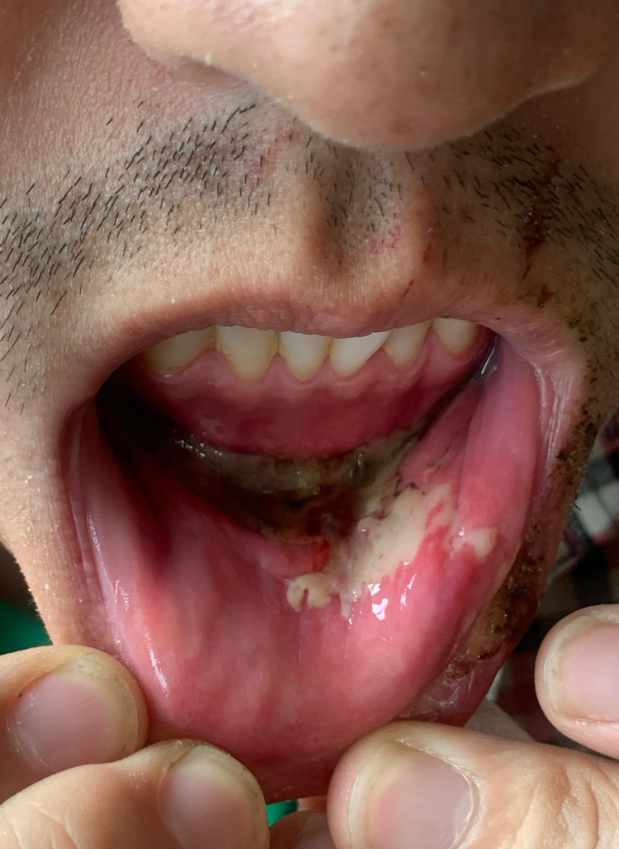 口腔溃疡表面的白色假膜不建议挑破