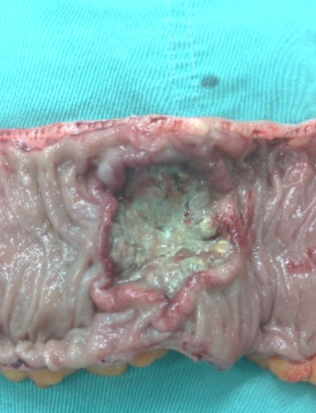 大便肛门疼痛最常见的原因是肛裂,肛周脓肿和直肠癌