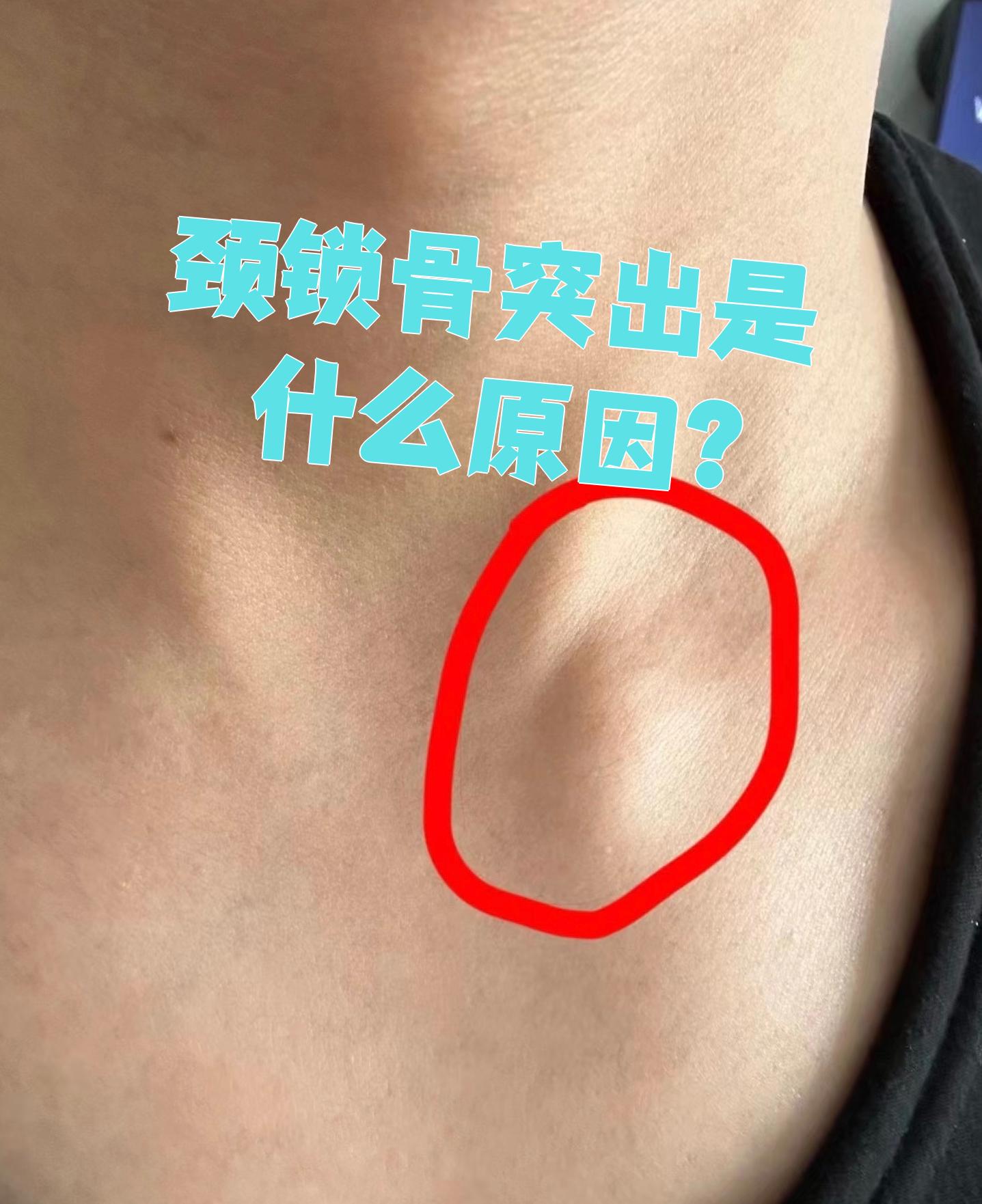 长时间保持不良姿势或过度劳累会导致颈部肌肉劳损,可能引起颈锁骨