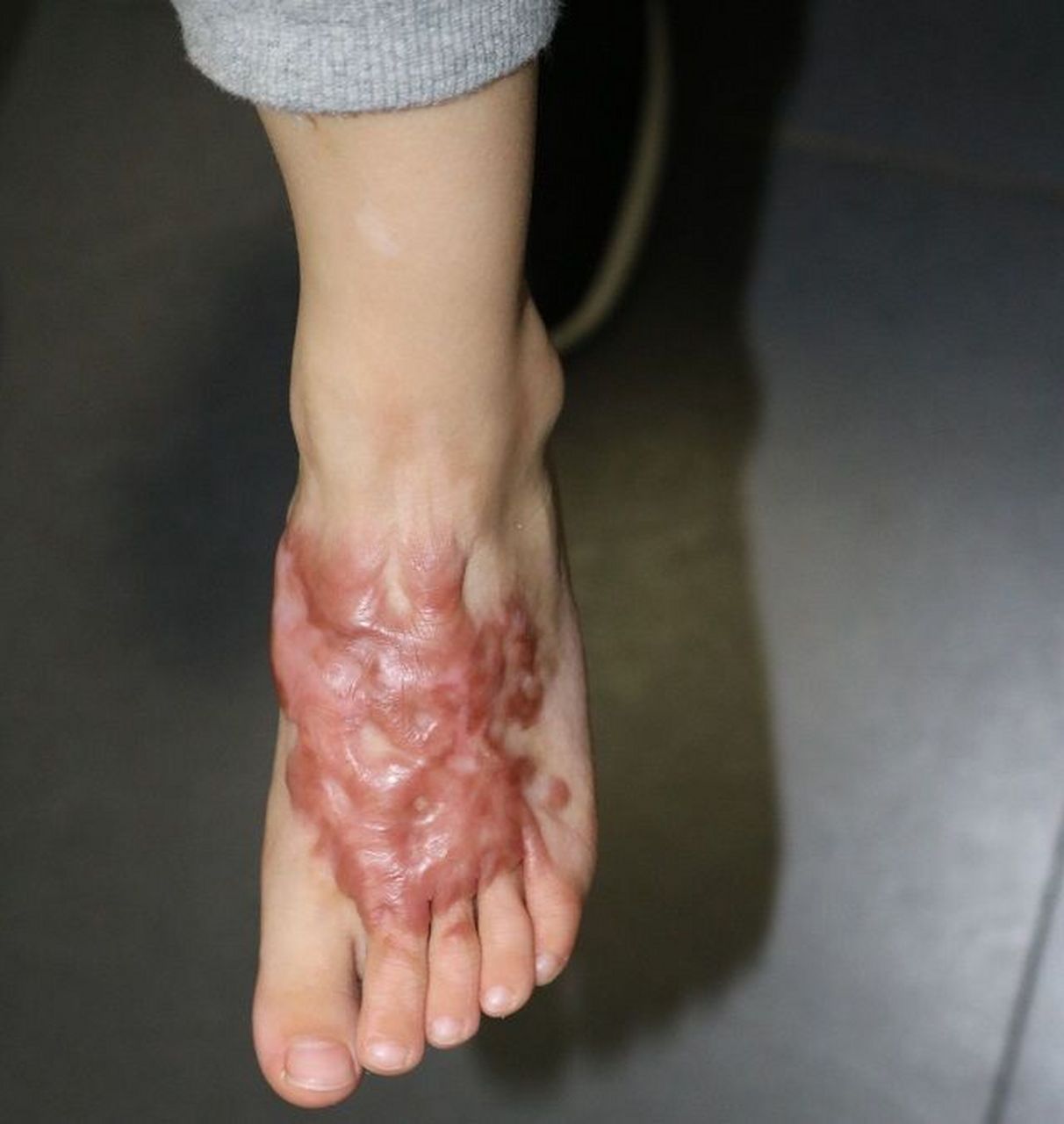 可以这样治疗 孩子脚部因烫伤出现了疤痕增生!