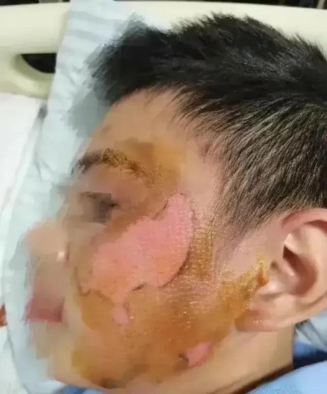 消防战士烧伤的脸图片