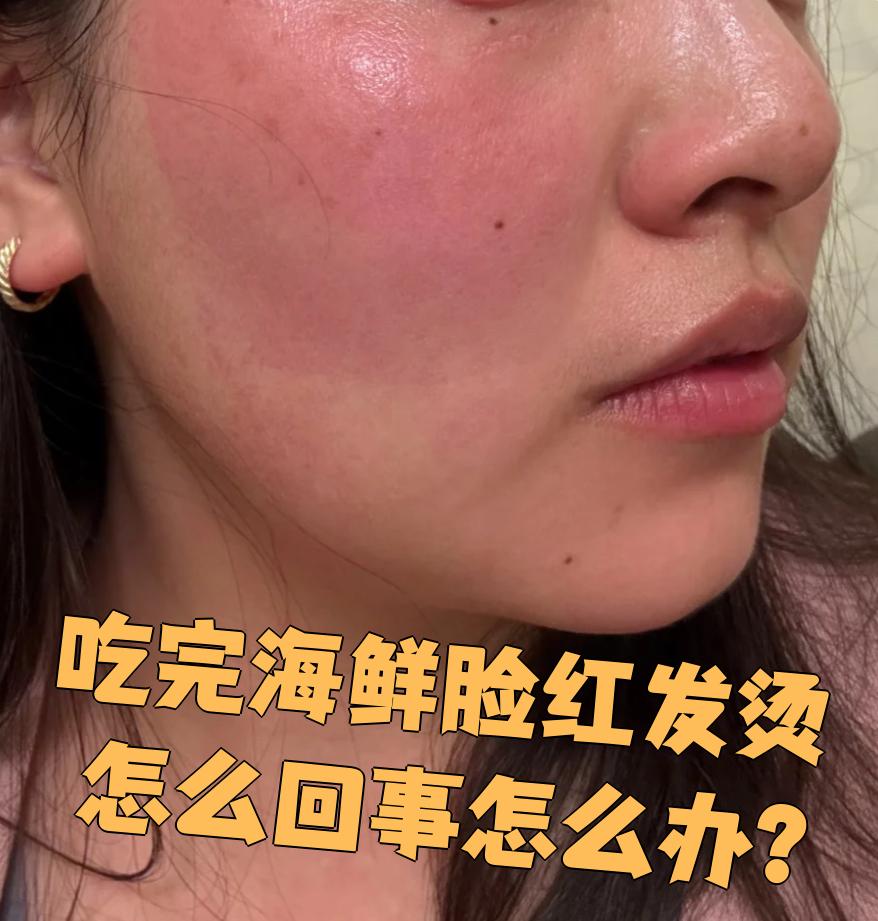吃完海鲜后脸红发烫,通常是过敏引起的