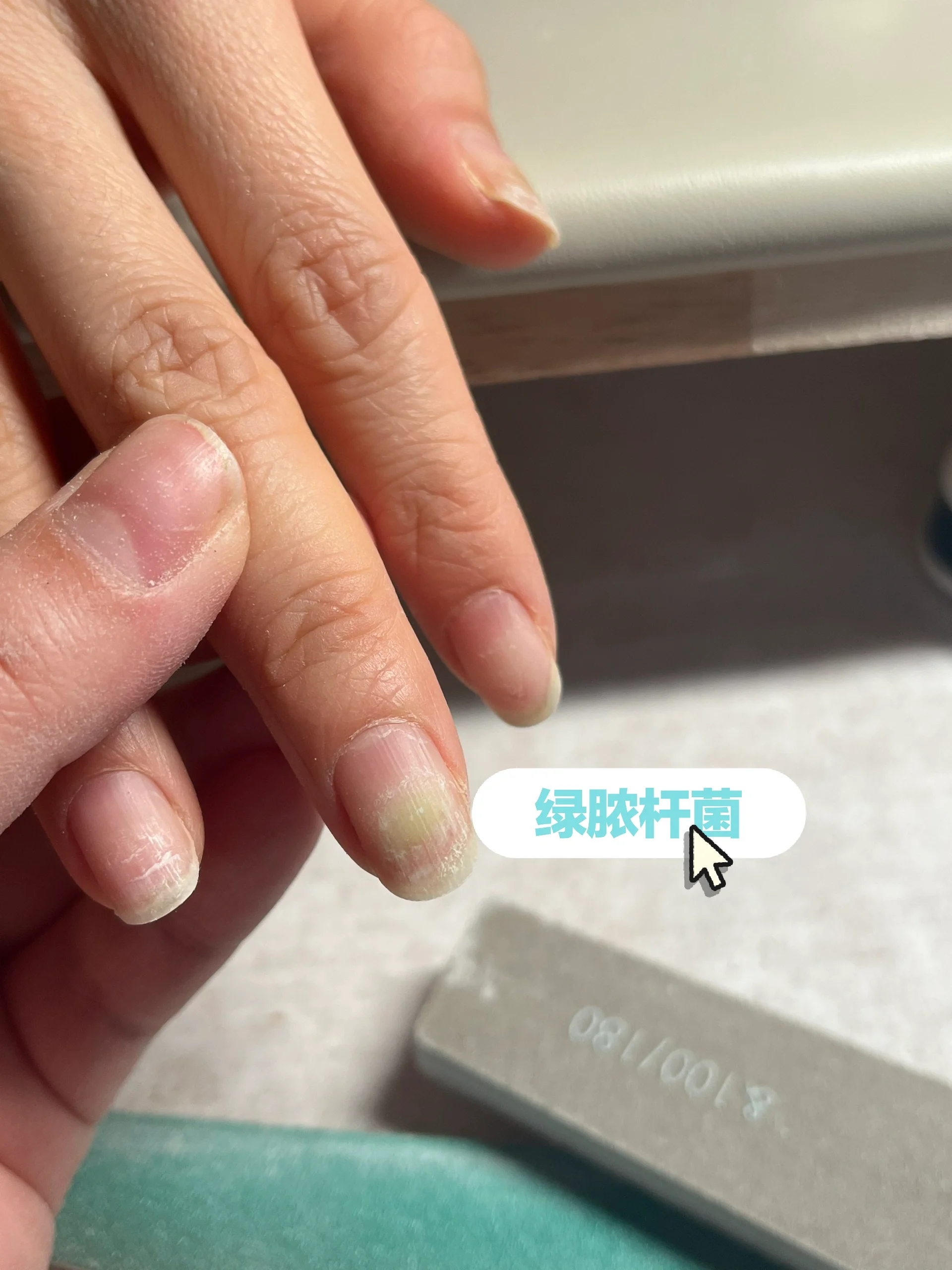 姐妹们千万不要为了省钱不卸除那半拉壳挤的指甲啊 感染绿脓杆菌原因