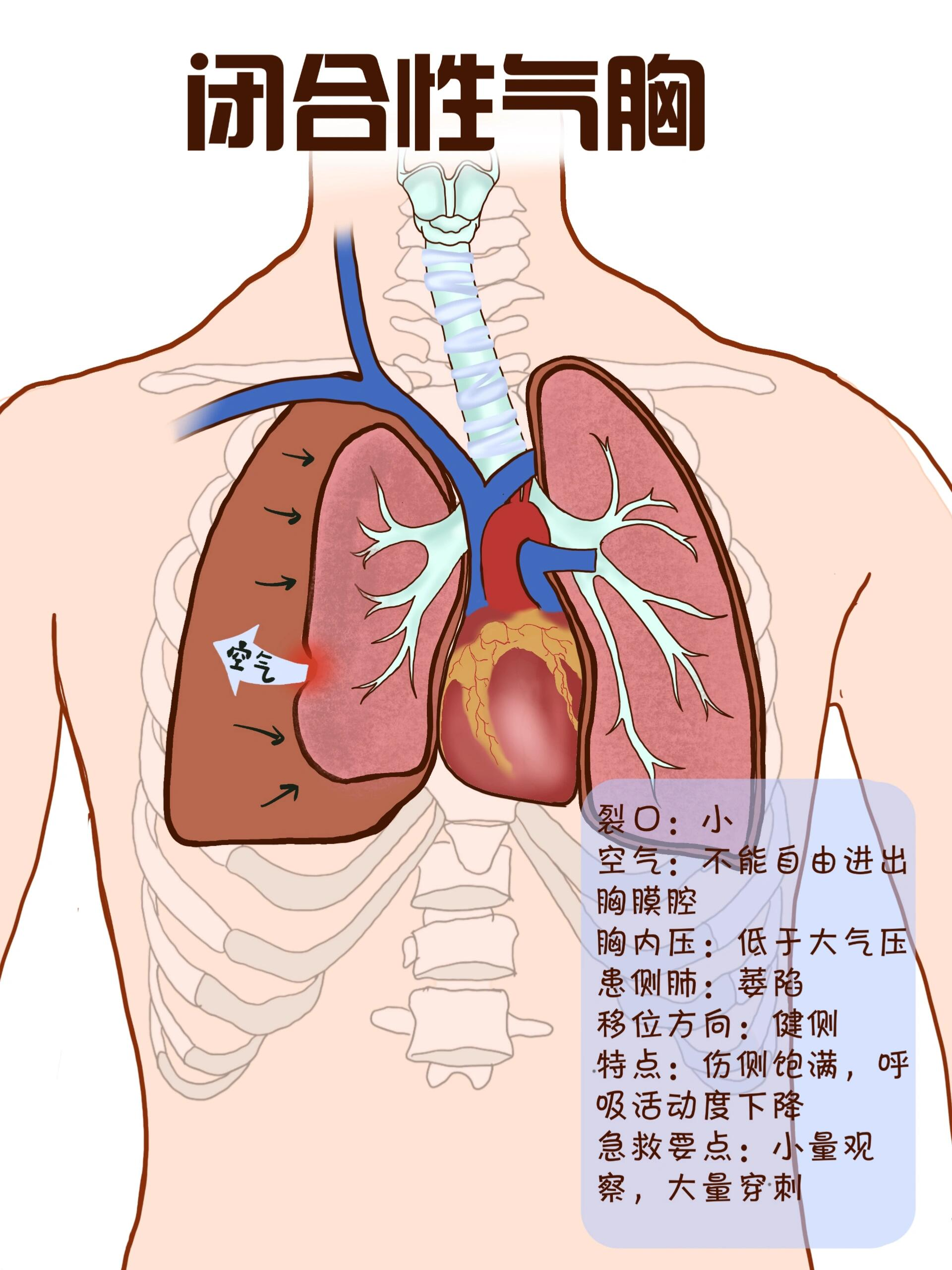 三种气胸的图片图片