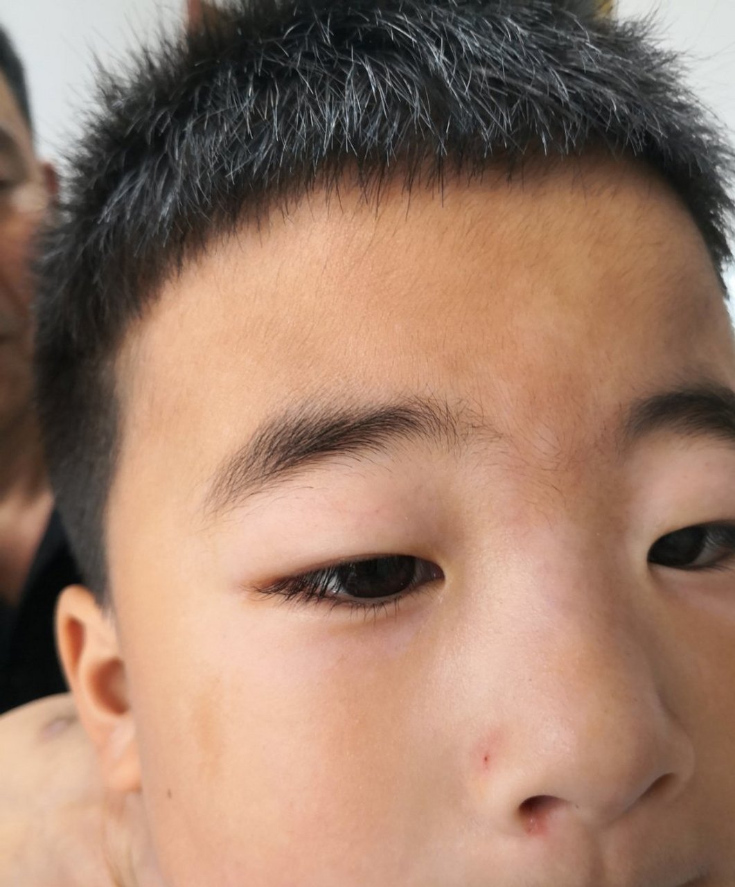 儿童面部淡色白斑有特应性皮炎的诊断考虑单纯糠疹