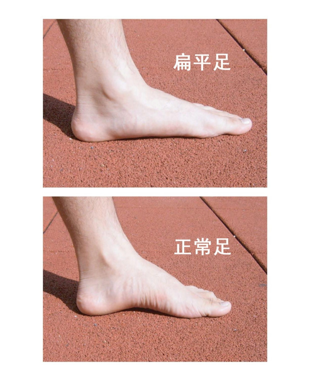 93扁平足又称平足症,指足弓低平或消失,患足外翻