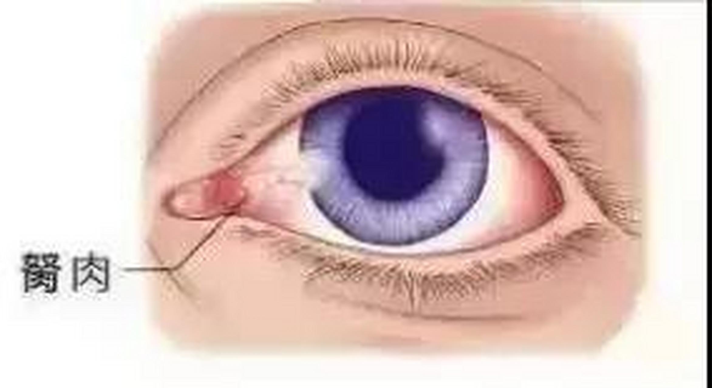 真相竟然是…… 胬肉是眼科常见病和多发病,医学称"翼状胬肉",俗称"翼