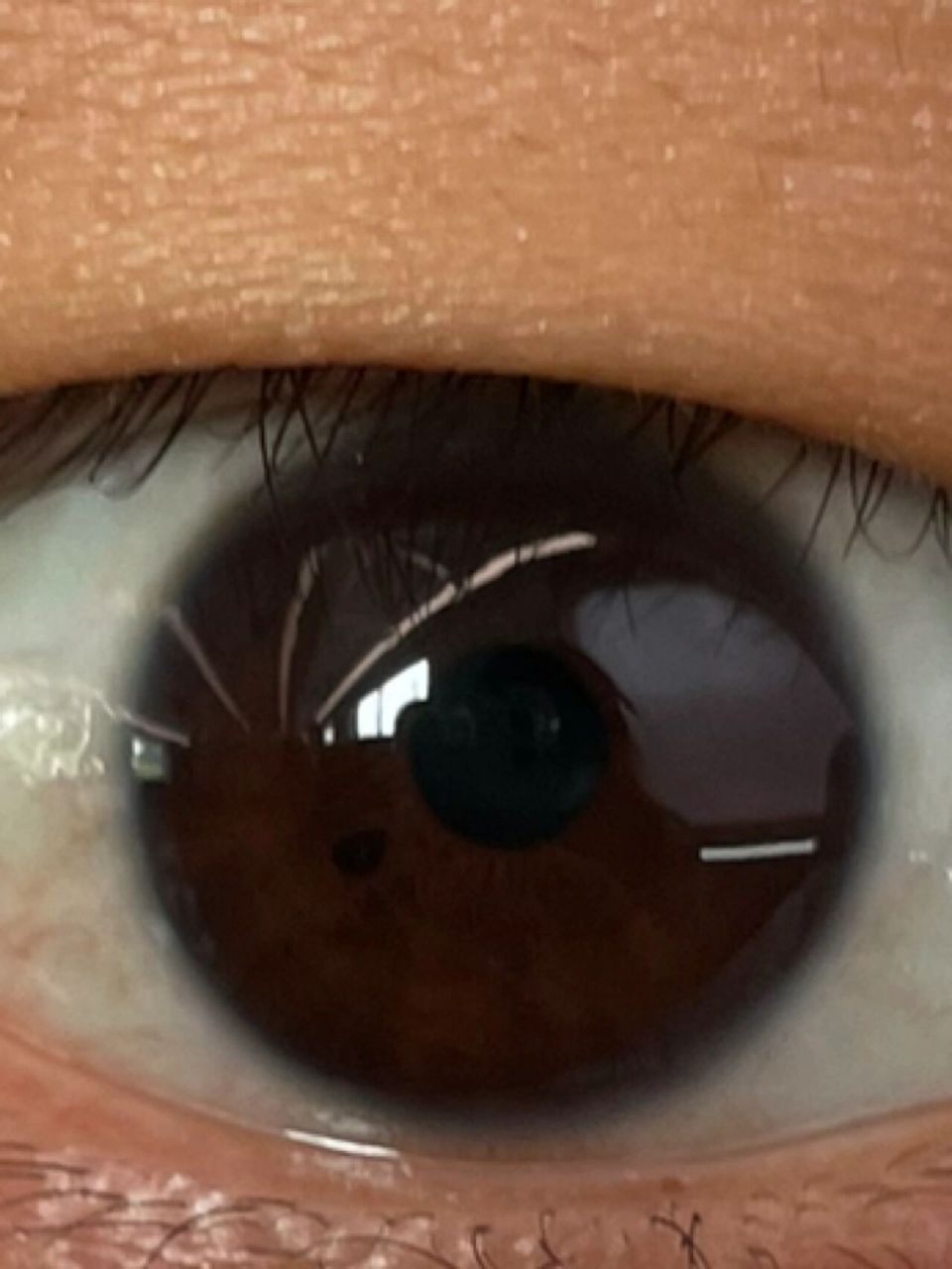 瞳孔旁边有个黑点是什么啊