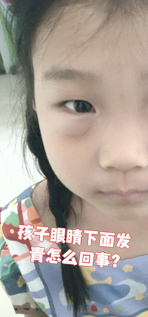 孩子眼睛下面发青很常见,通常不是什么大问题