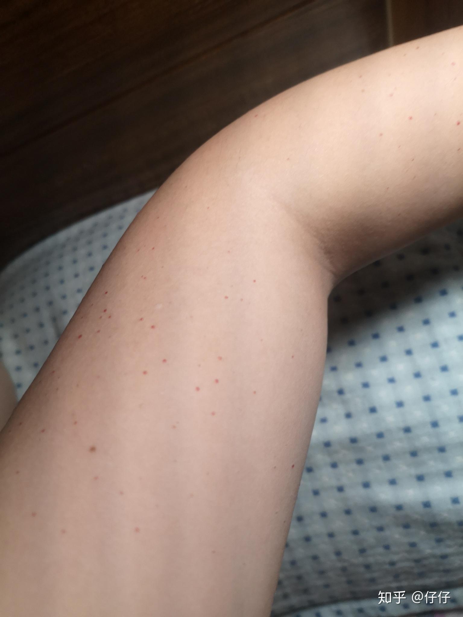 手臂上有不少好像因为血小板产生的小红点点