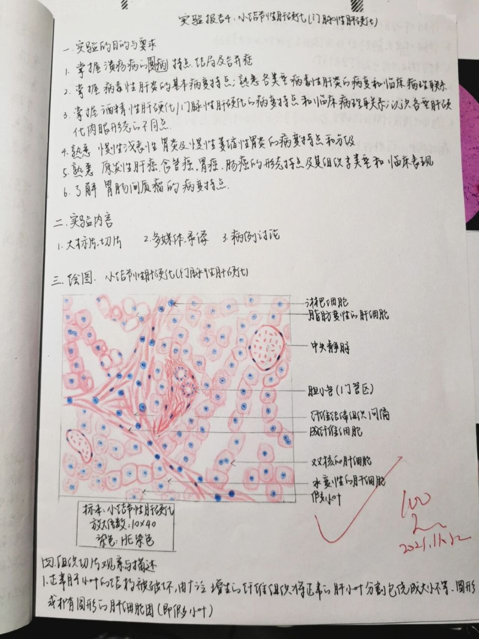 肝硬化手绘图实验报告图片