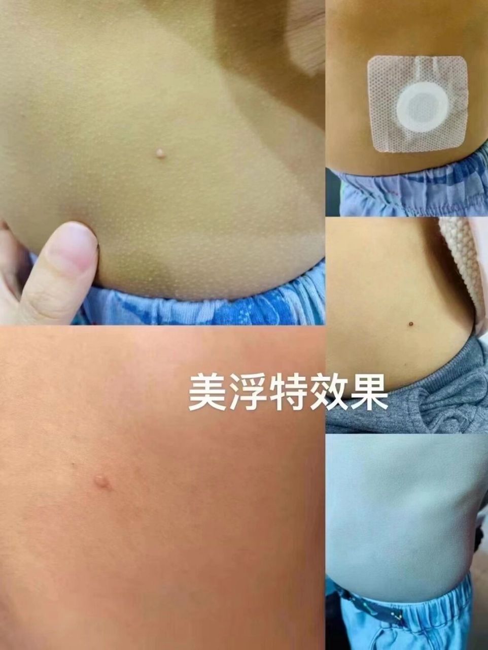 小朋友软疣反馈 小孩子也会长疣 67用美浮特的去疣凝露涂的效果96
