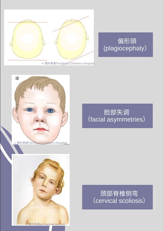 先天性肌斜颈图片