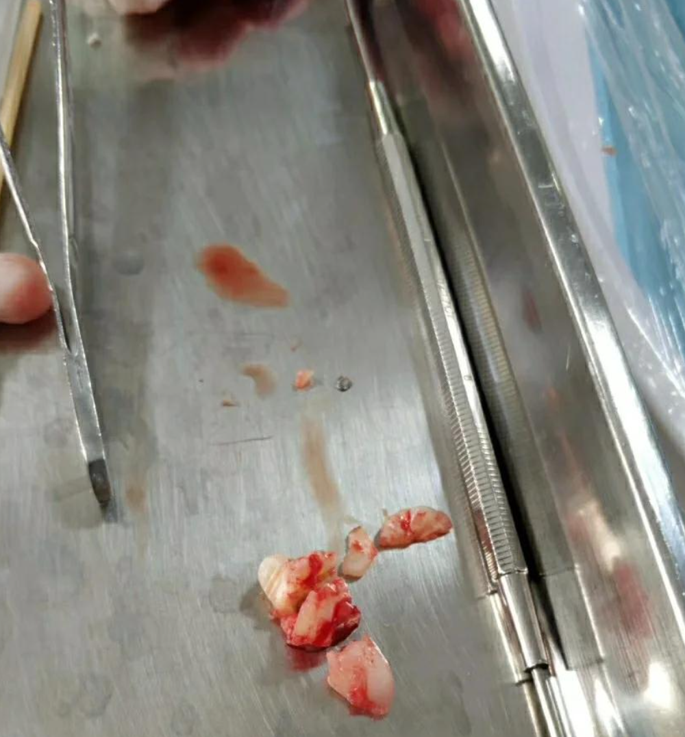 牙龈上突然多长出一颗牙,可能是多生牙,畸形牙或者智齿