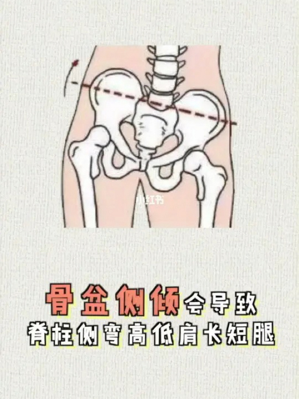 骨盆后倾的症状图片图片