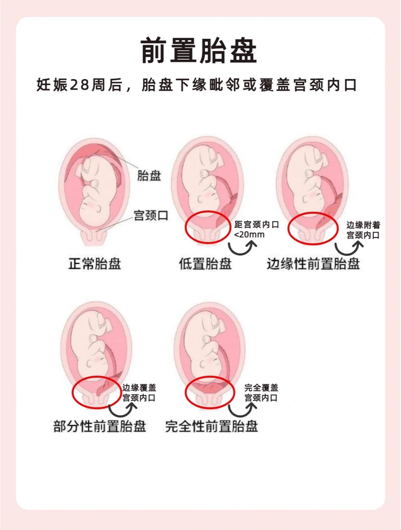 前置胎盘/胎盘低/中央型都是什么样? 看图就很清晰了.