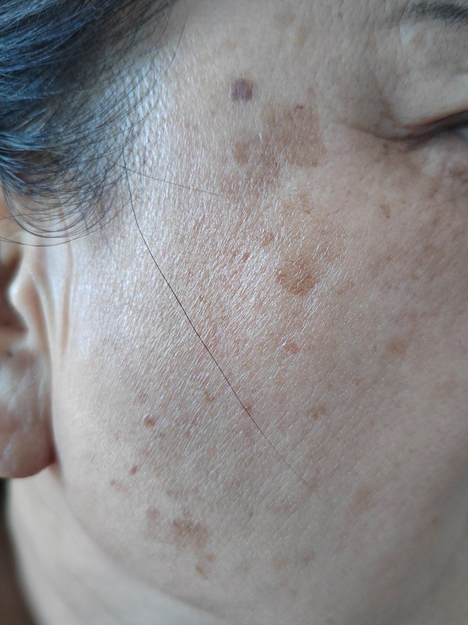 面部脂溢性角化/老年斑症状.