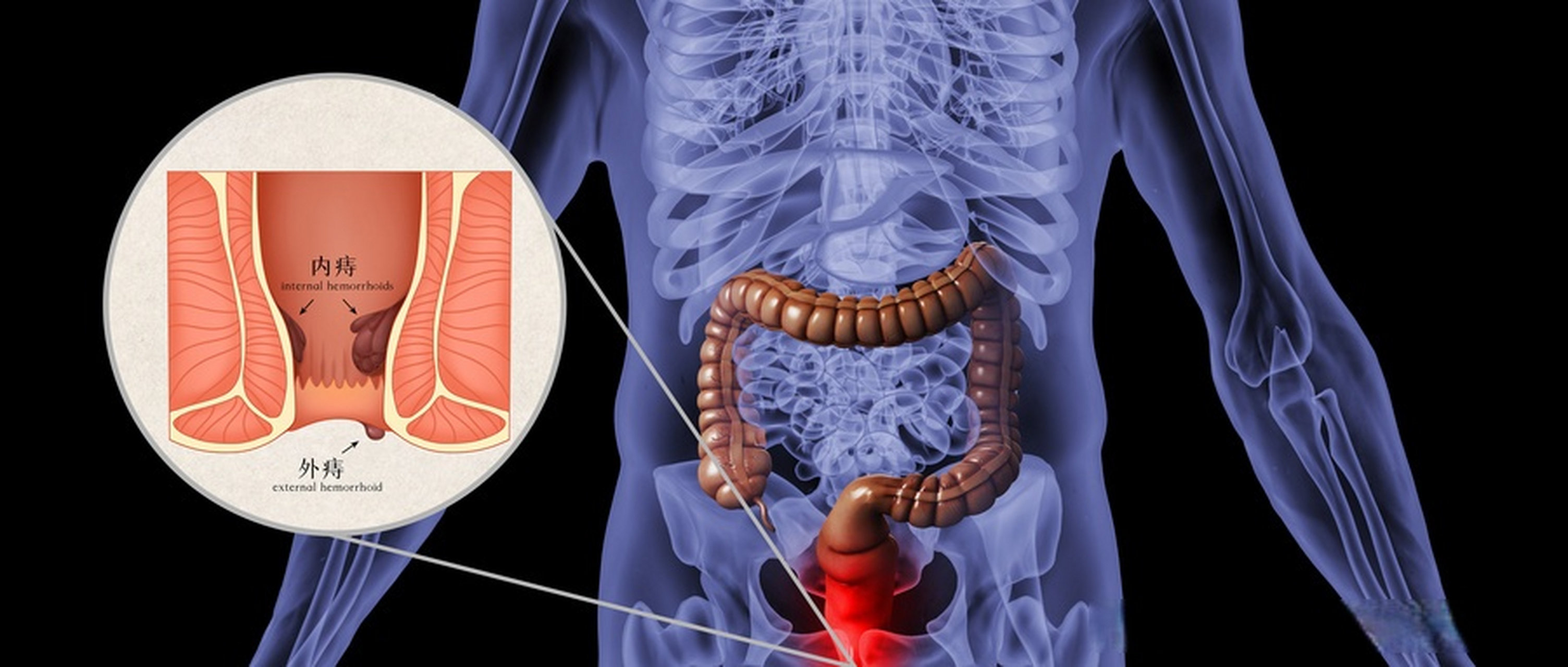 痔疮嵌顿是什么意思图片
