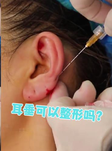耳垂是可以整形的,目前常用的方法有玻尿酸注射和自体脂肪填充两. 