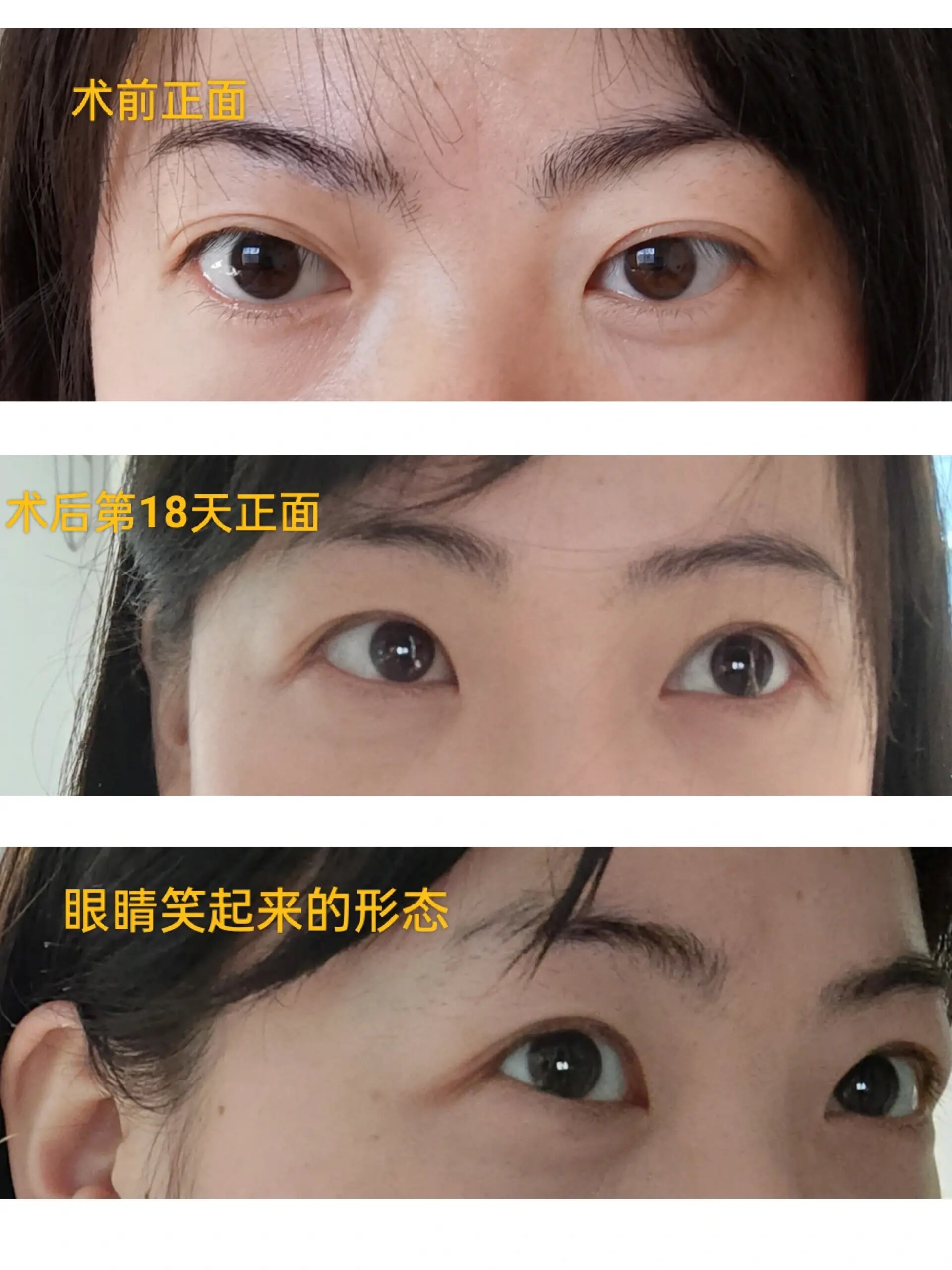 眼眶减压(突眼矫正)成功上岸第18天 眶减压第18天,眼部持续消肿,犹如