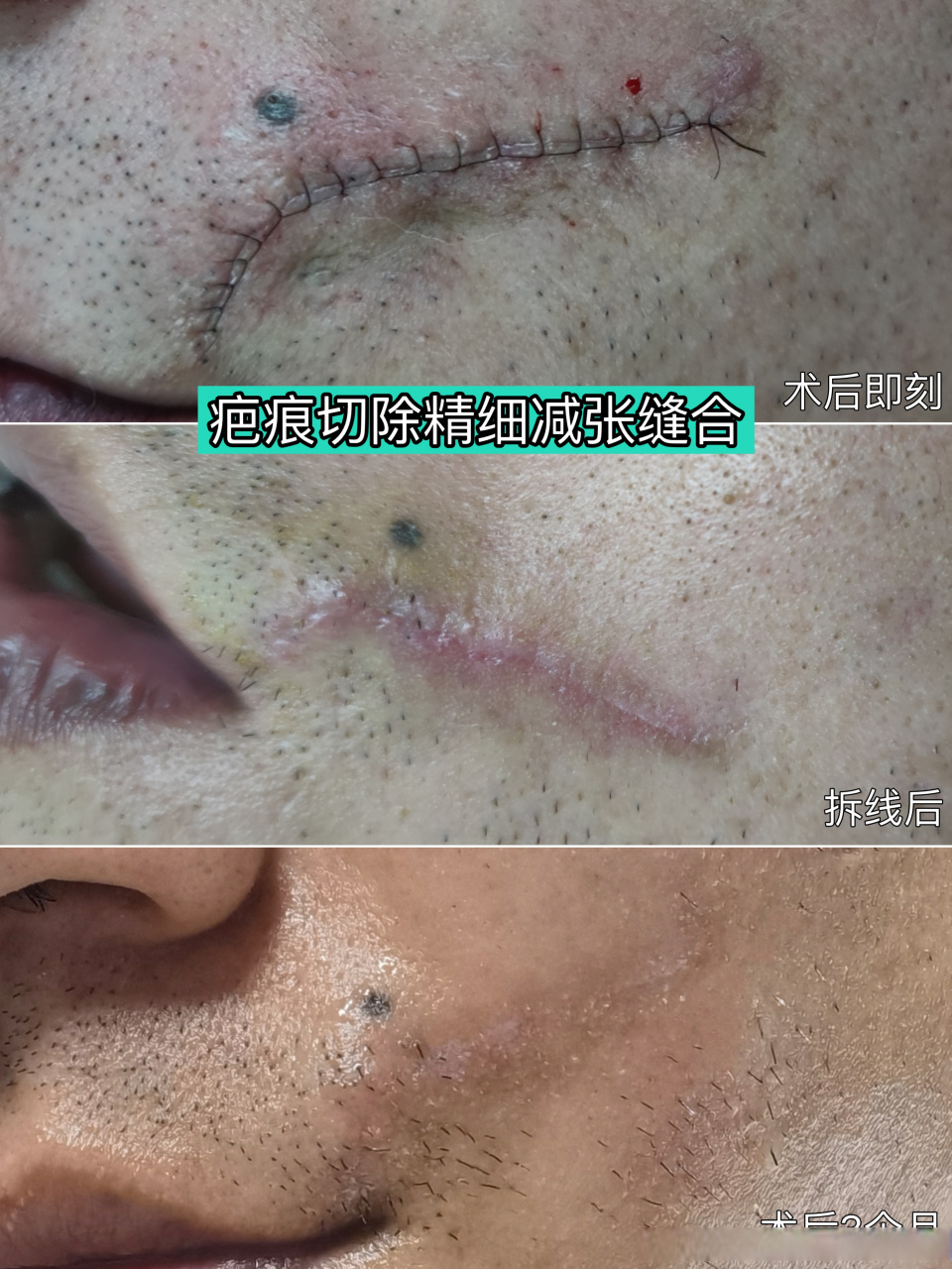 论美容减张缝合的重要性6015 同样是疤痕切除术,不同的缝合方式