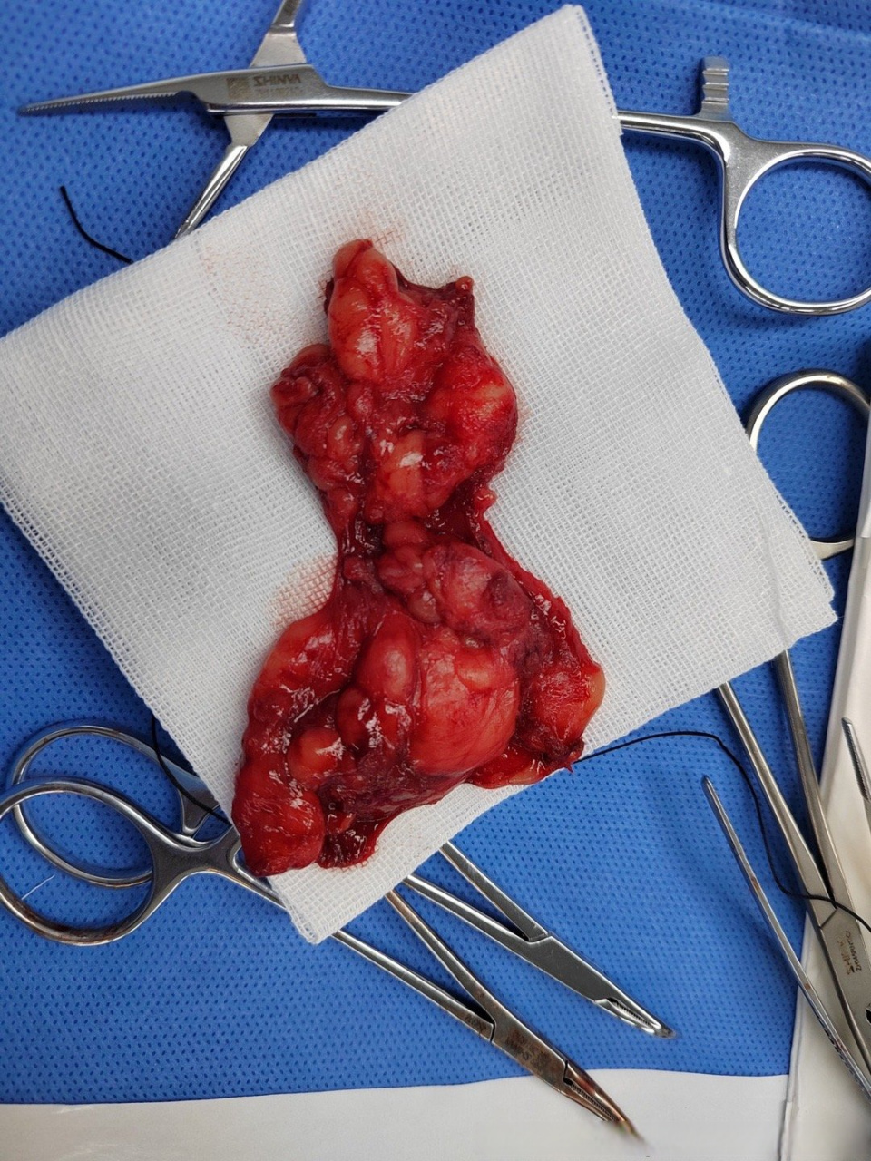 无论自体脂肪填充(如图)还是生物补片的丁丁增大,当求诊者准备想恢复