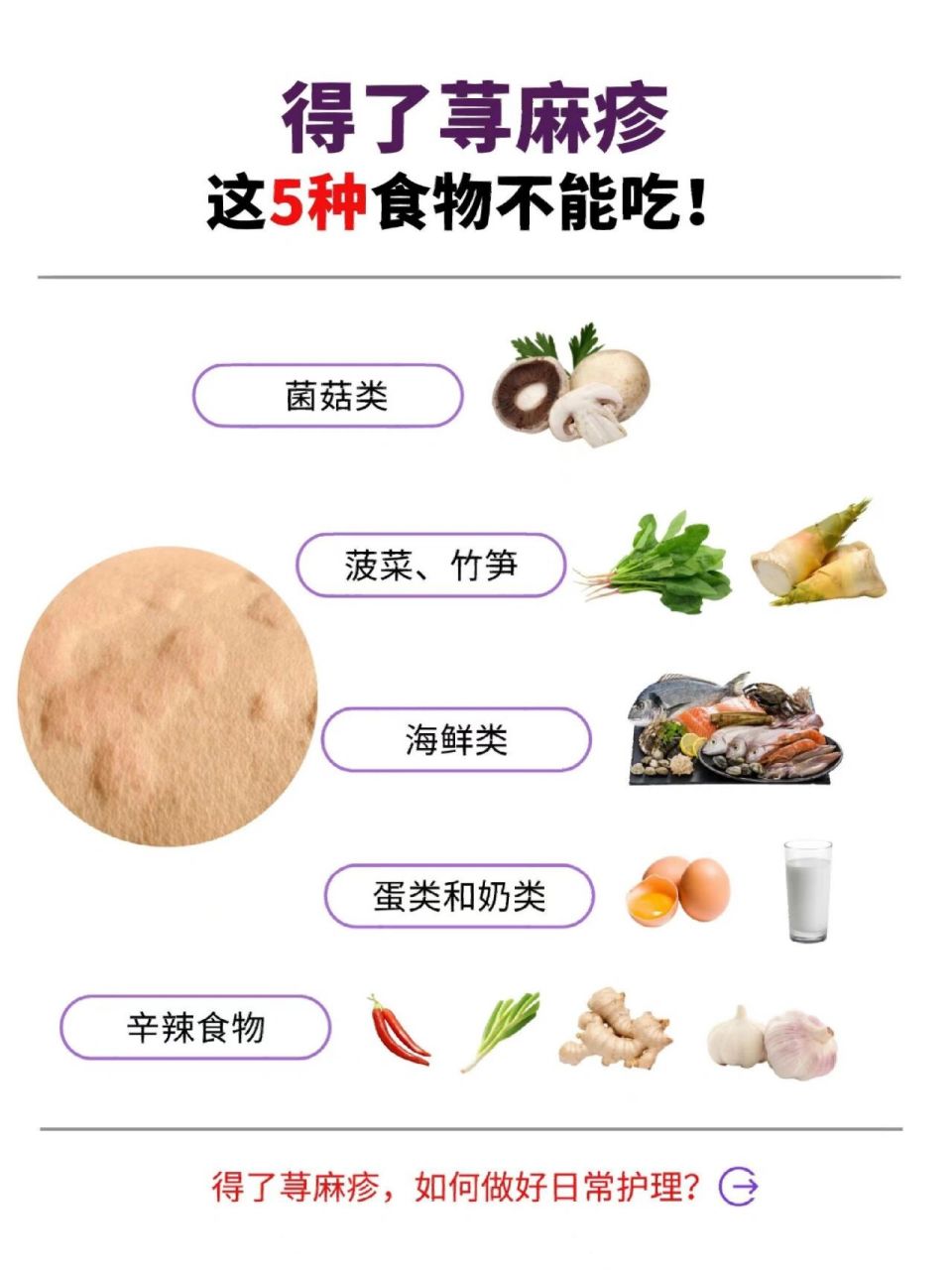 春季小心"荨麻疹",这5种食物不能吃!