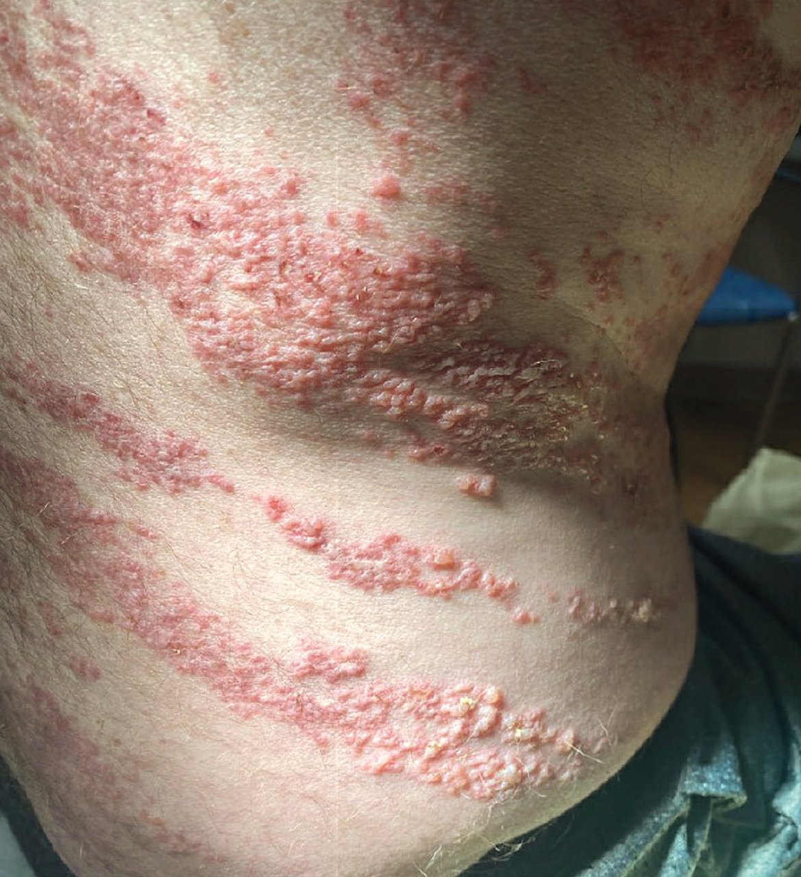 线状毛囊角化病  一名 69 岁的男性因背部和右躯干发痒,灼热的皮疹 1